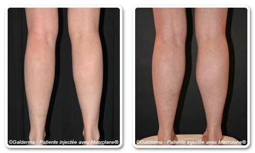 Calves injections - before after in Dubai | The Champs-Elysées Clinic