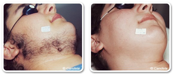 Men's laser beard hair removal in Dubai | The Champs Elysées medical Clinic