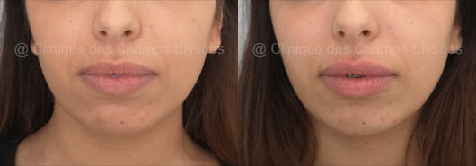 Lip Augmentation, before after in Dubai: Champs-Elysées Clinic