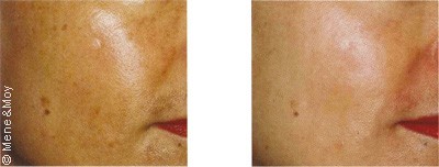 Brown spots, pregnancy mask, keratoses treatments in Dubai - Before After Picture